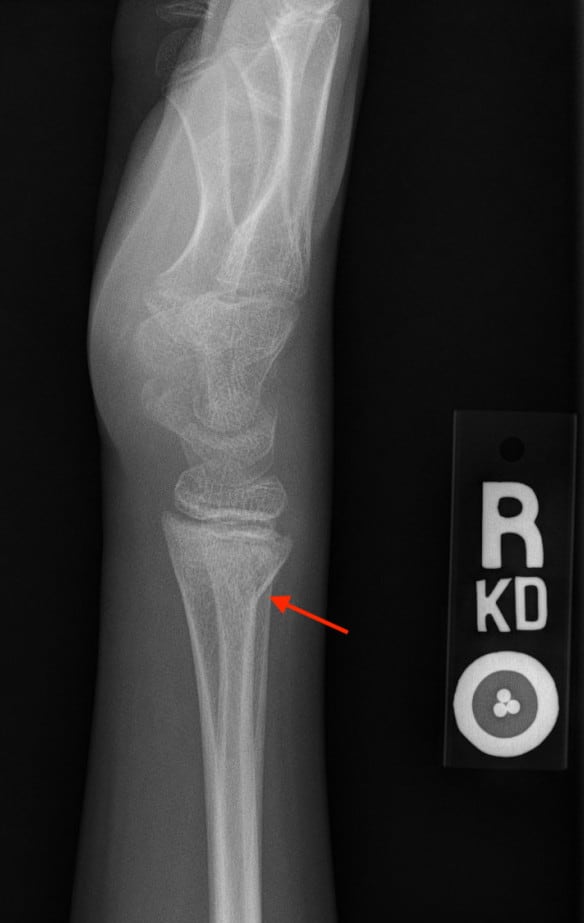 Wrist Radiograph - Buckle/Torus Fracture