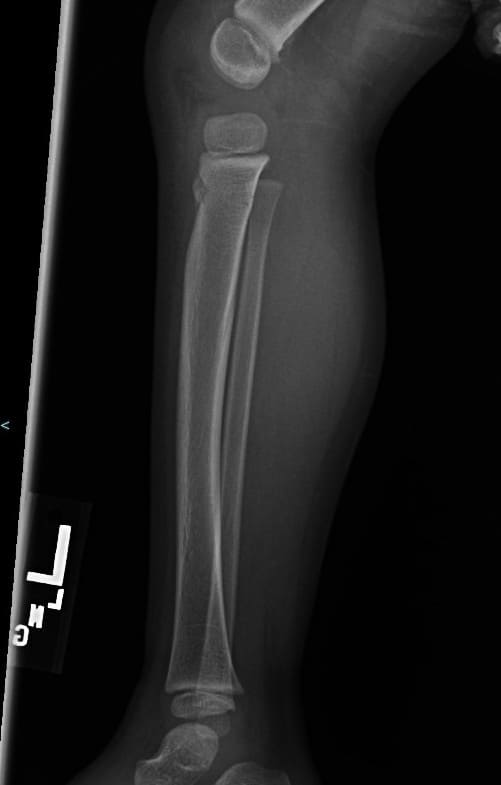 Lower Extremity Radiograph - No obvious fracture post trampoline injury