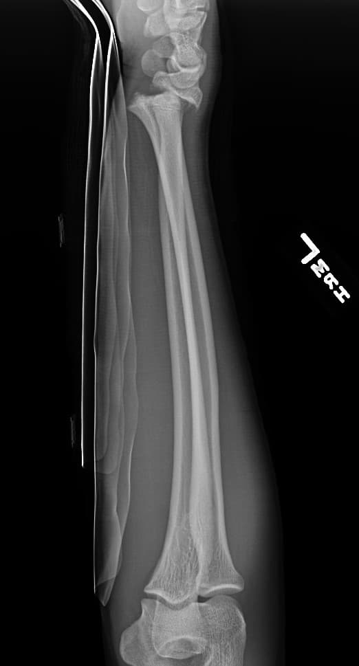 Forearm Radiograph - Salter 1 fracture