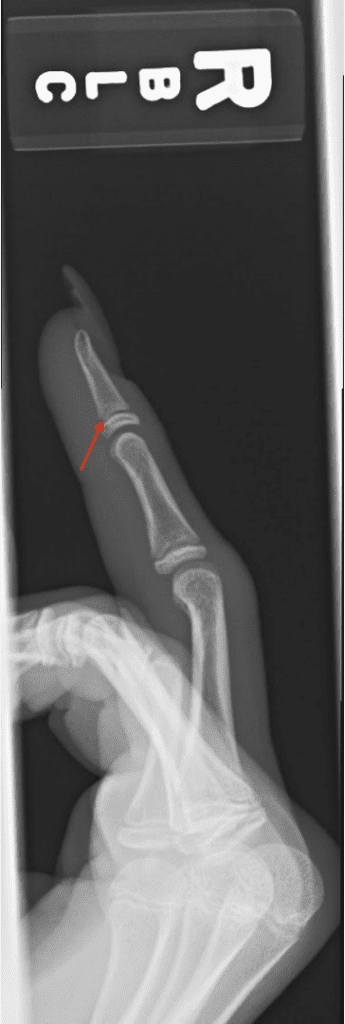 Lateral Hand Radiograph - Salter Harris 2 fracture