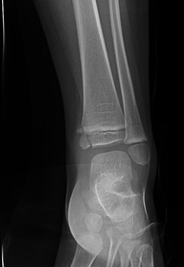 Wrist Radiograph - Salter Harris Type 4 fracture