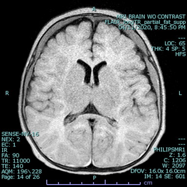 Axial FLAIR image demonstrates hyperintense subdural hematomas predominantly located in the bilateral frontoparietal convexity. Note that the most sensitive standard sequence is FLAIR as the appearance of a hematoma varies with the biochemical state of hemoglobin which is dependent on the age of the hematoma resulting in varying intensity on the T1 and T2 MR sequences. 