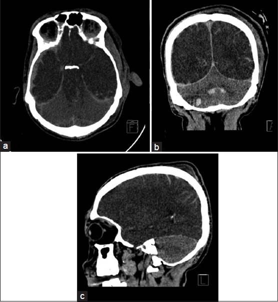 Computed tomography scans in (a) Axial, (b) Coronal, and (c) Sagittal sections showing with right-sided acute subdural hematoma, bilateral hypodense cerebral hemispheres, and brain stem, complete cisternal effacement, and patchy contusions. The