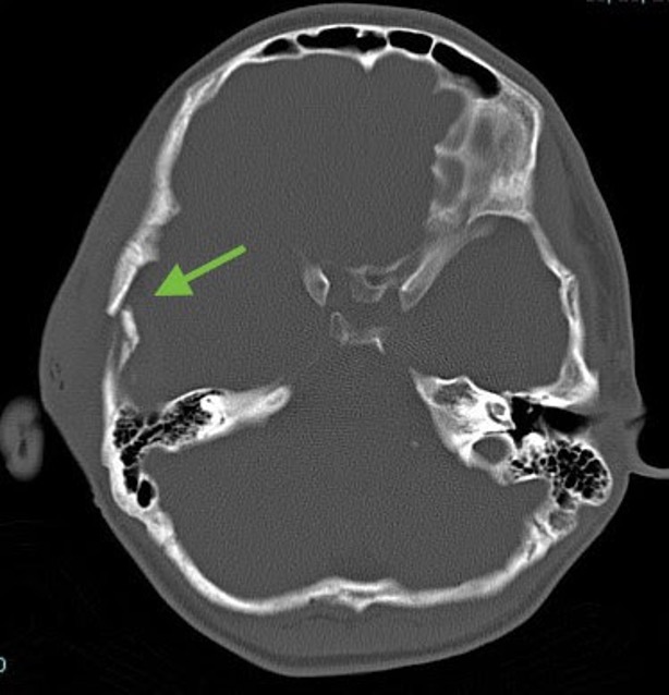 axial head ct image showing skull fracture