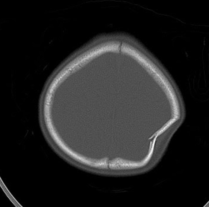 axial CT in bone windows showing parietal bone fracture