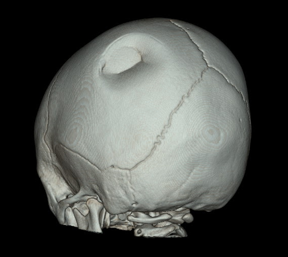 3D skull reconstruction 
