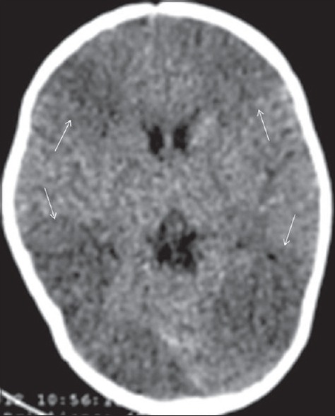 Non contrast head CT axial