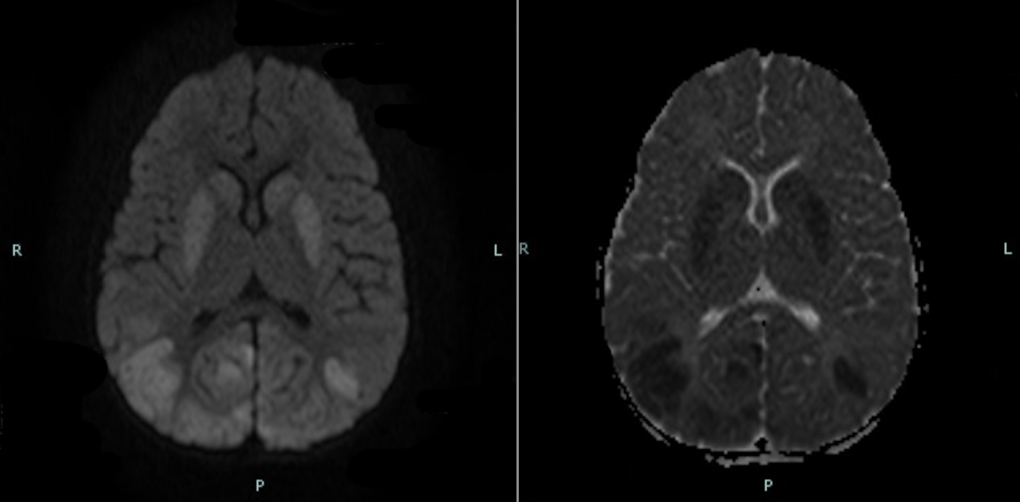 Hypoxic-Ischemic Injury | UAMS Department of Radiology