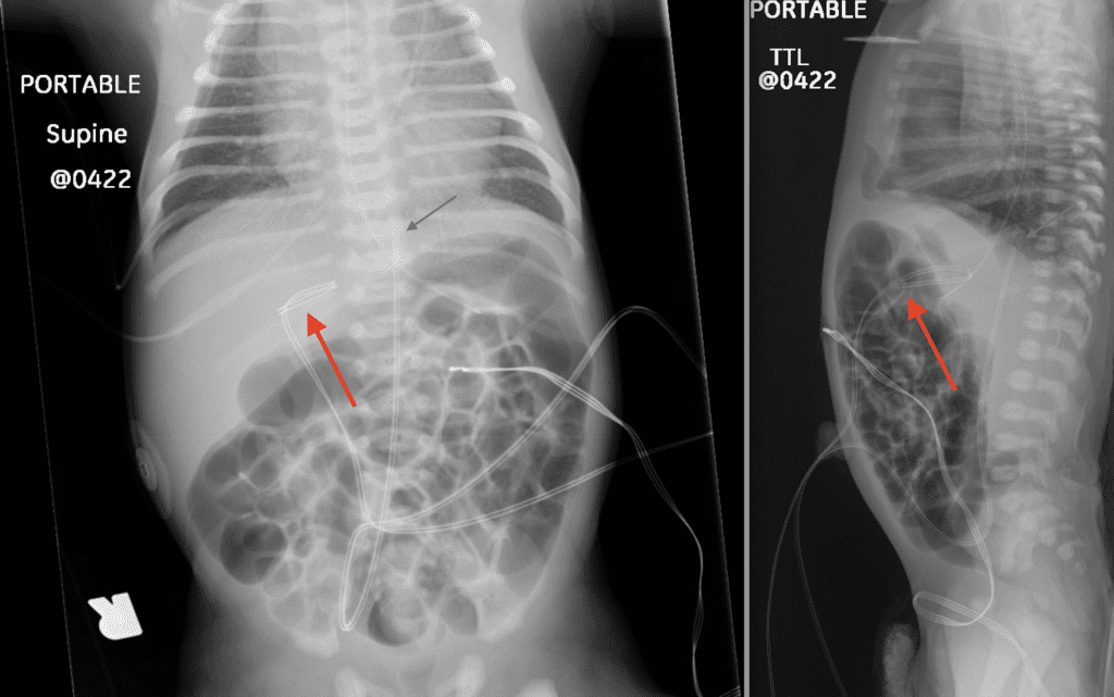 Frontal and Cross Table X-Rays - Umbilical Lines