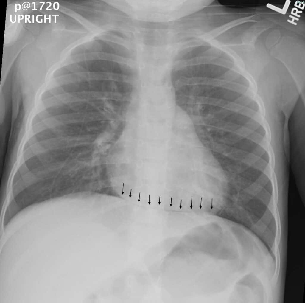 Chest X-ray - Continuous Diaphragm Sign
