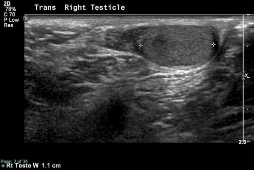 Scrotal Ultrasound - Right transverse testicle