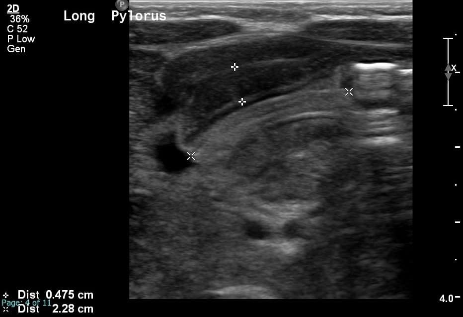 Ultrasound image of pylorus