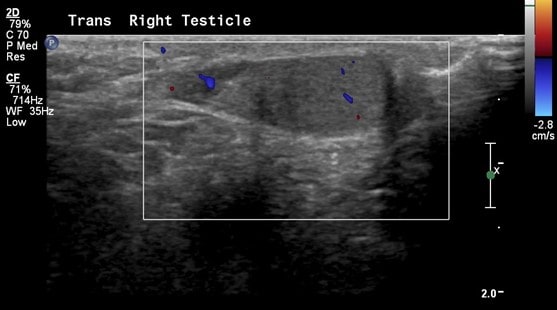 Scrotal Ultrasound - Transverse Right Testicle