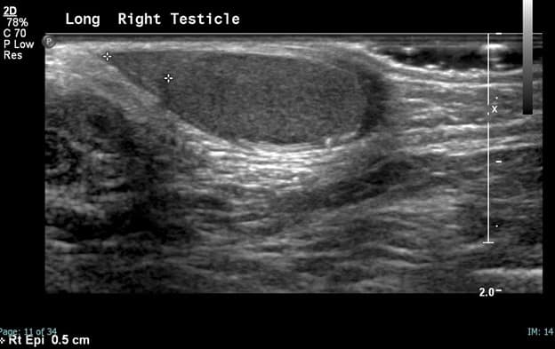 scrotal ultrasound of the right testicle