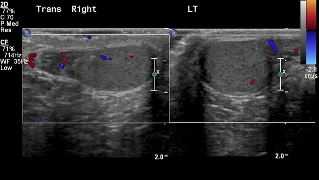 Scrotal Ultrasound - Longitudinal views of Epididymii