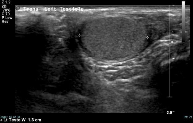 Scrotal Ultrasound - Left Transverse Testicle