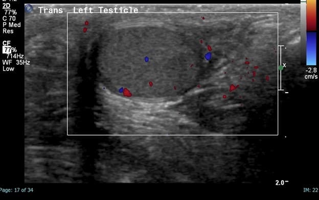 Scrotal Ultrasound - Transverse Left Testicle