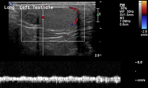 Scrotal Ultrasound - Doppler of Left Testicle