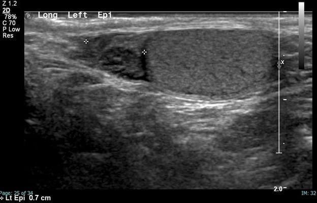 Ultrasound - Infarcted Testicular Appendage