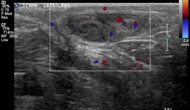 Scrotal Ultrasound - Infarcted Testicular Appendage with Doppler