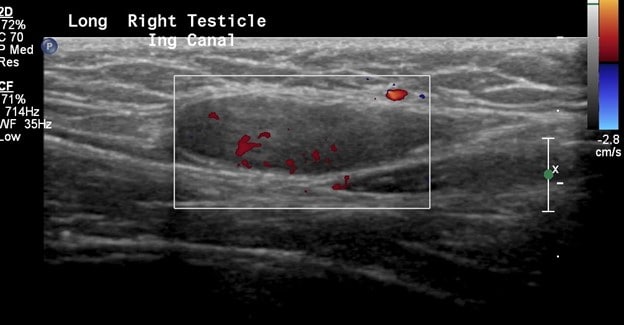 Inguinal Ultrasound - Doppler flow of Testis in Inguinal Canal