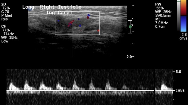 Inguinal Ultrasound - Doppler flow of Testis in Inguinal Canal with waveform