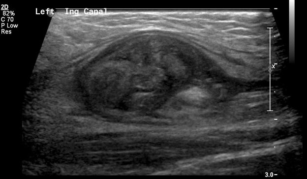 Ultrasound - Left Inguinal Canal with heterogenous mass