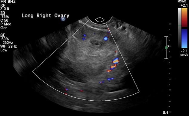 color US image of the ovary