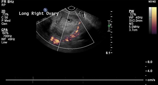 power doppler US image of the ovary