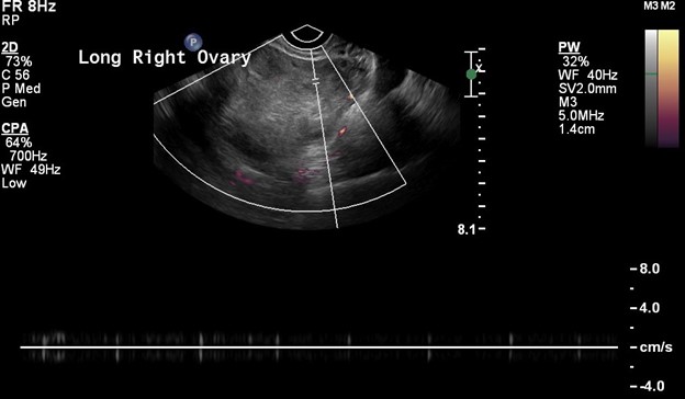 power doppler US image of the ovary