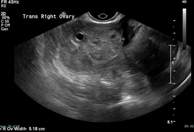 greyscale US image of the ovary