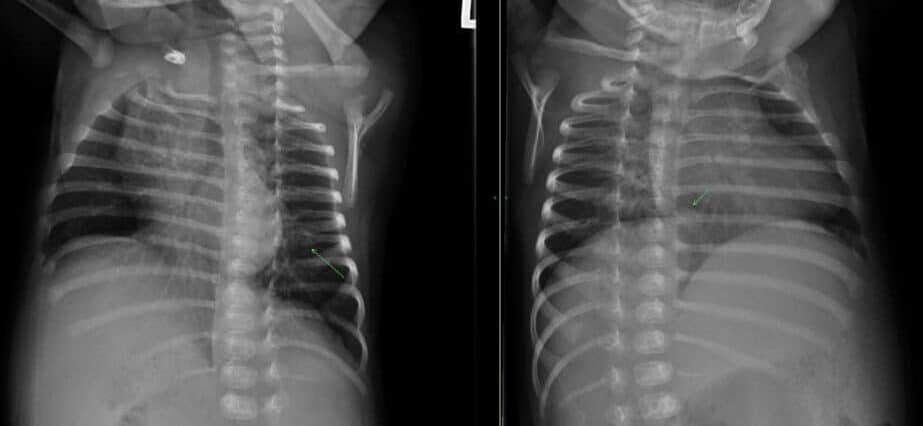Oblique Chest Radiograph - Rib fractures suspicious of non accidental trauma
