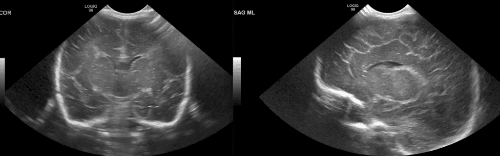 Sagittal & Coronal Head Ultrasound - Normal Anatomy
