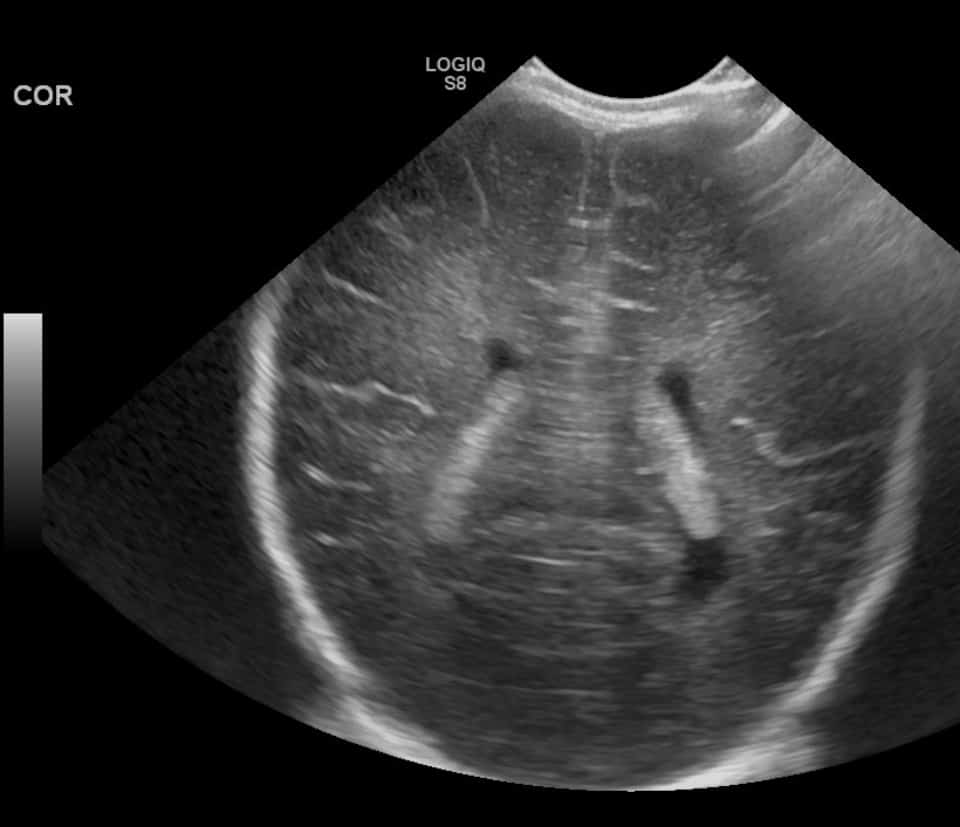 Coronal Head Ultrasound - Hyperechoic choroid plexus
