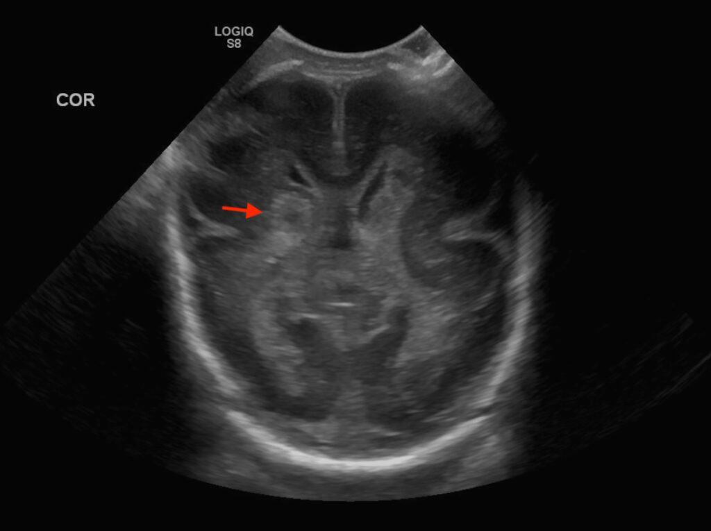 Cranial Ultrasound UAMS Department Of Radiology